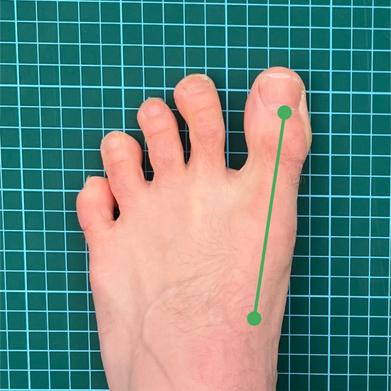 Straight big toe