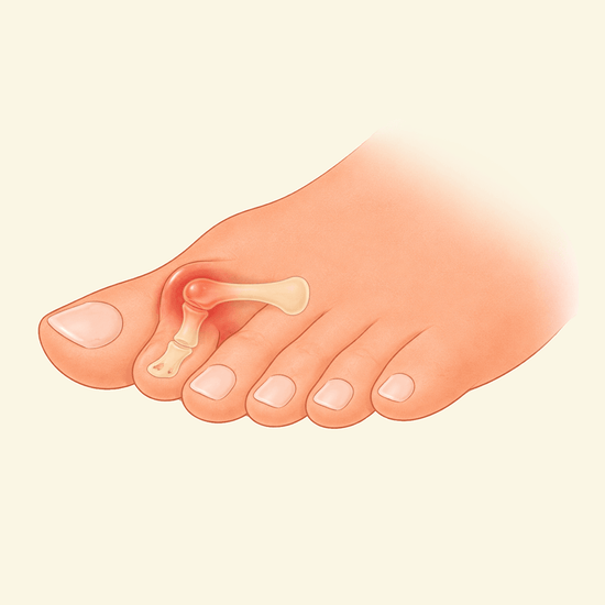Hammer Toes